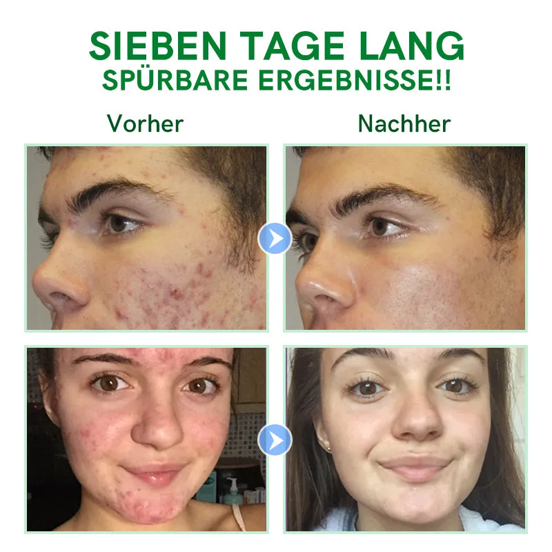 Furzero Follikel Akne Reinigen Creme